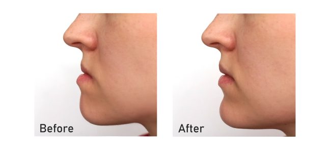 Orthognathic Surgery