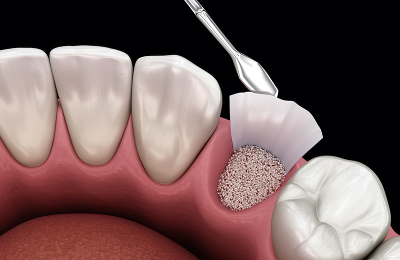 Types of Bone Grafting We Perform