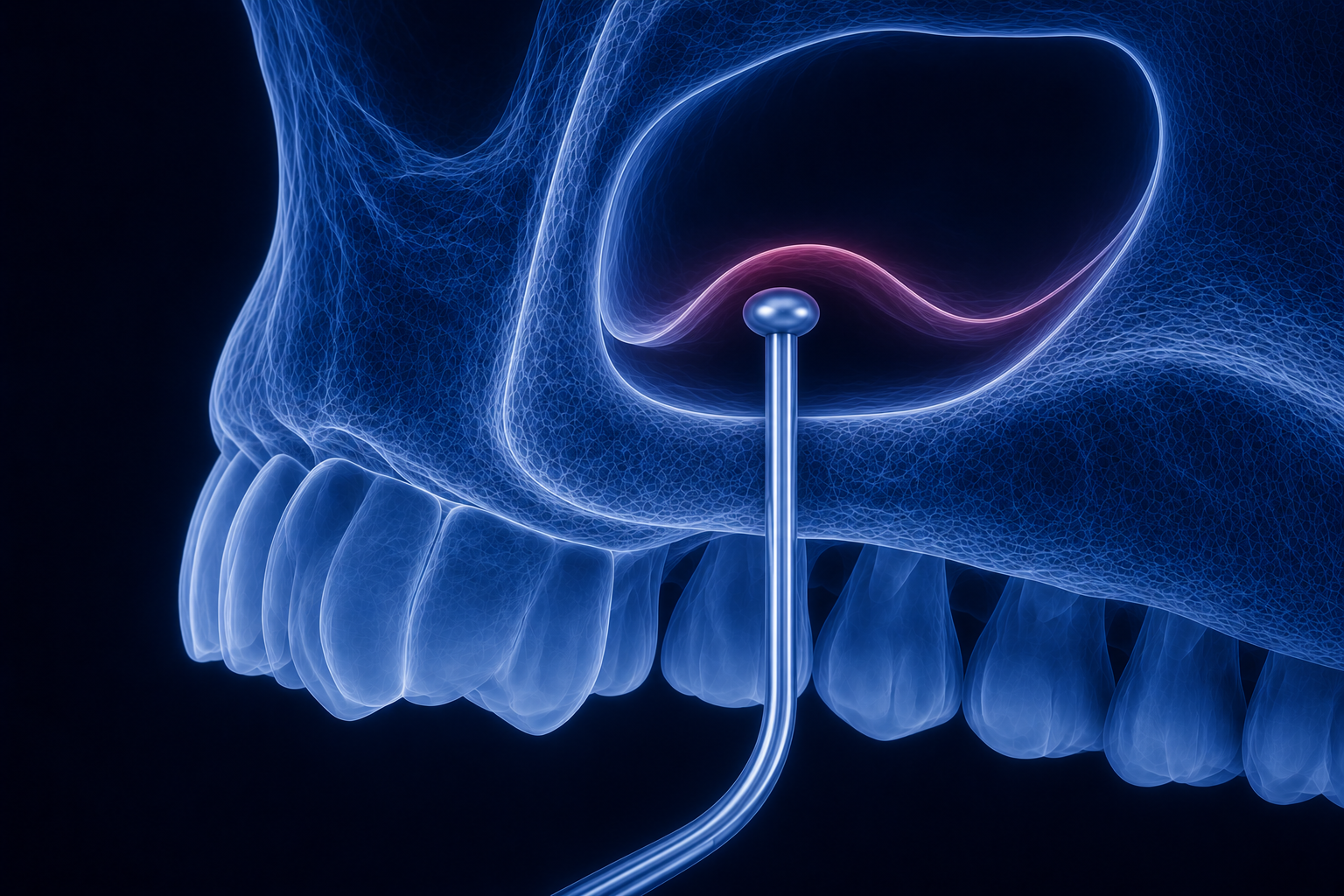 Sinus Lifts