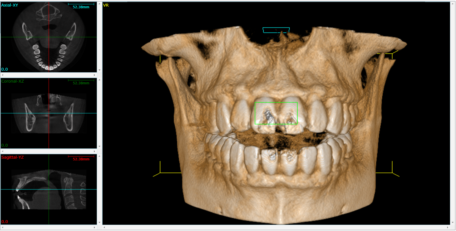 Cone Beam CT Scan (CBCT)