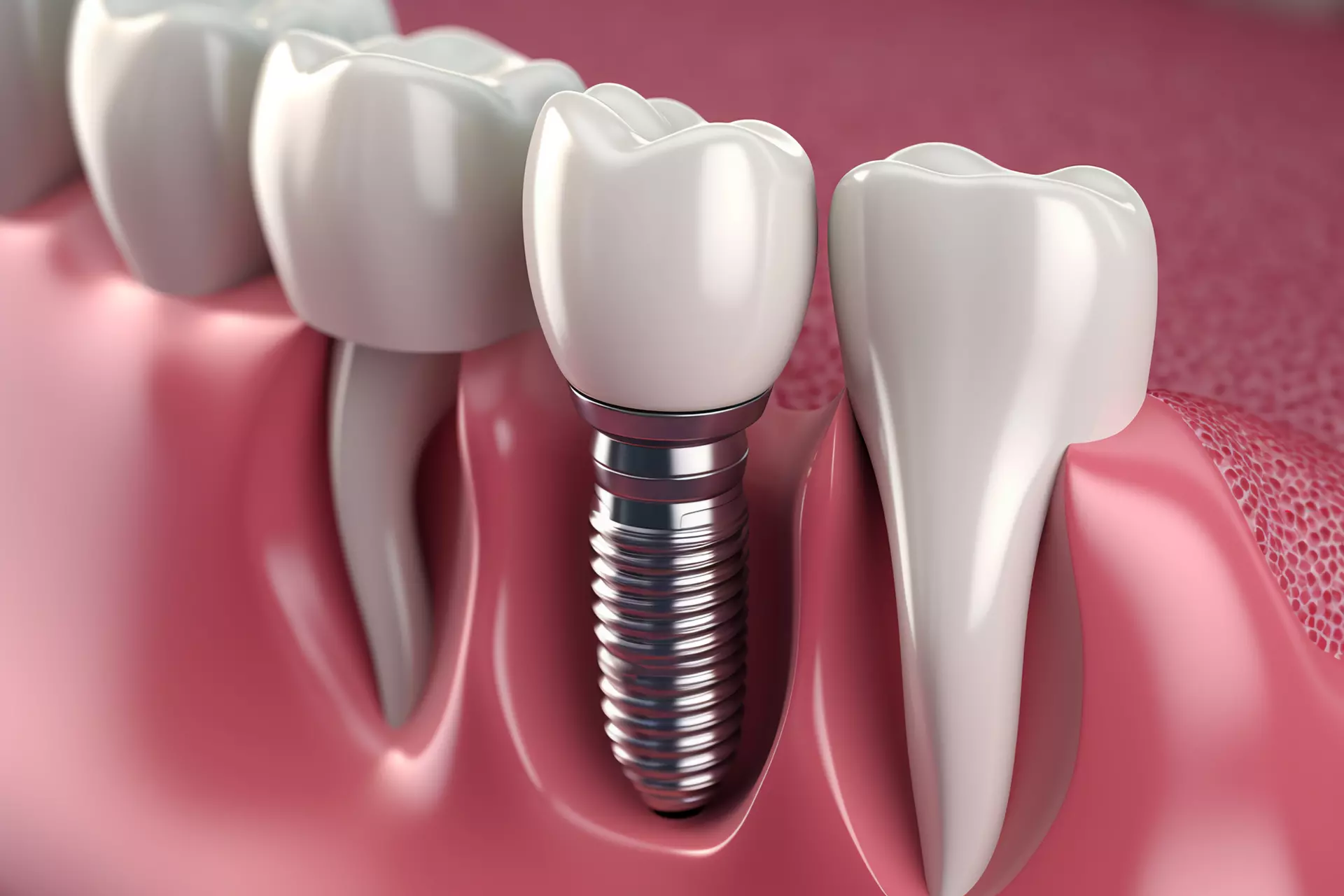 Zygomatic Implants