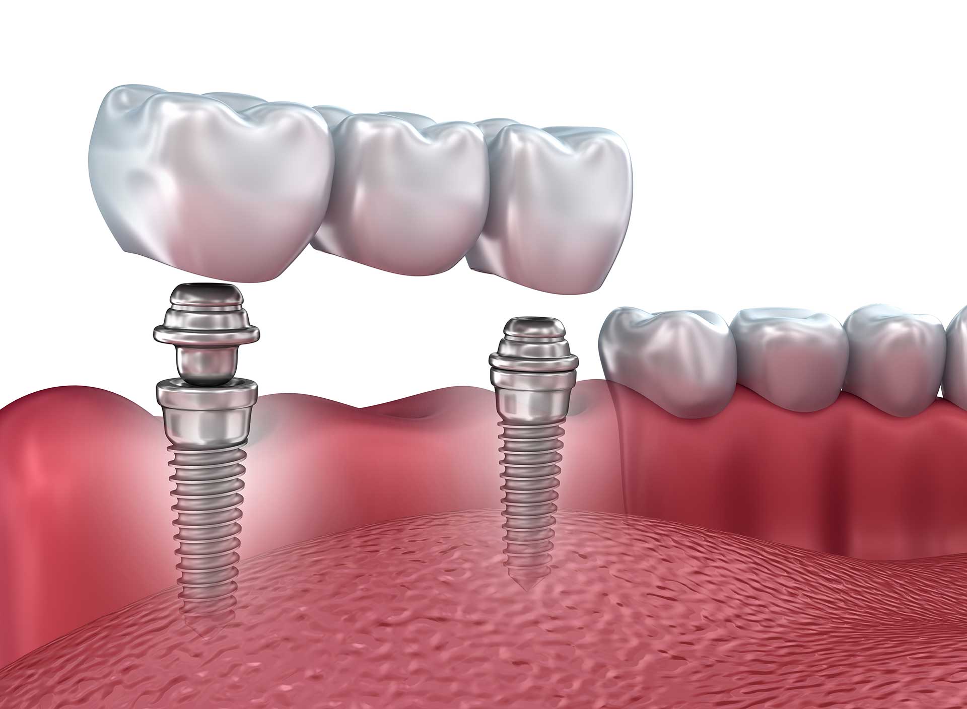 Guided Dental Implant Surgery