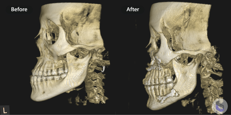 Corrective Jaw Surgery