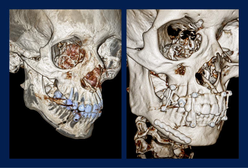 Facial Trauma Treatment in Pompano Beach & Coral Springs