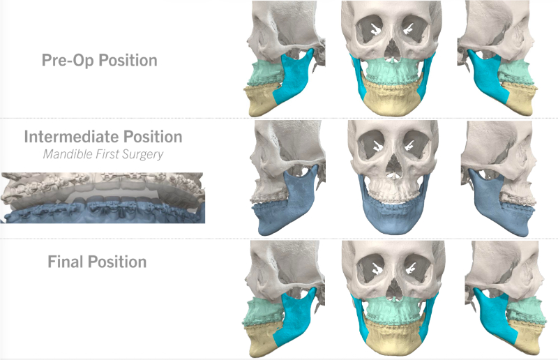 Virtual Surgical & Aesthetic Planning in Pompano Beach & Coral Springs