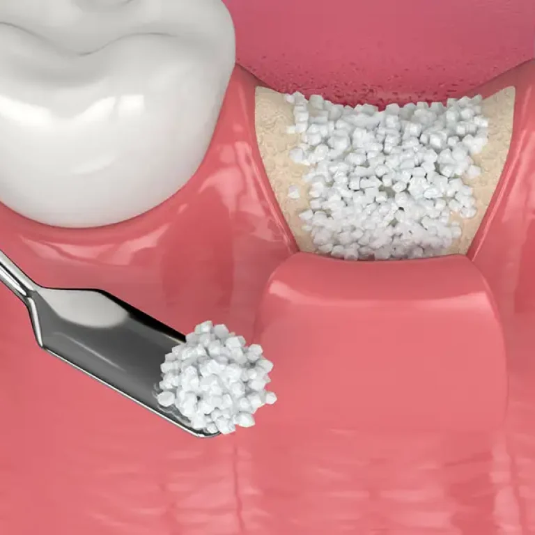 Bone grafting for dental implants