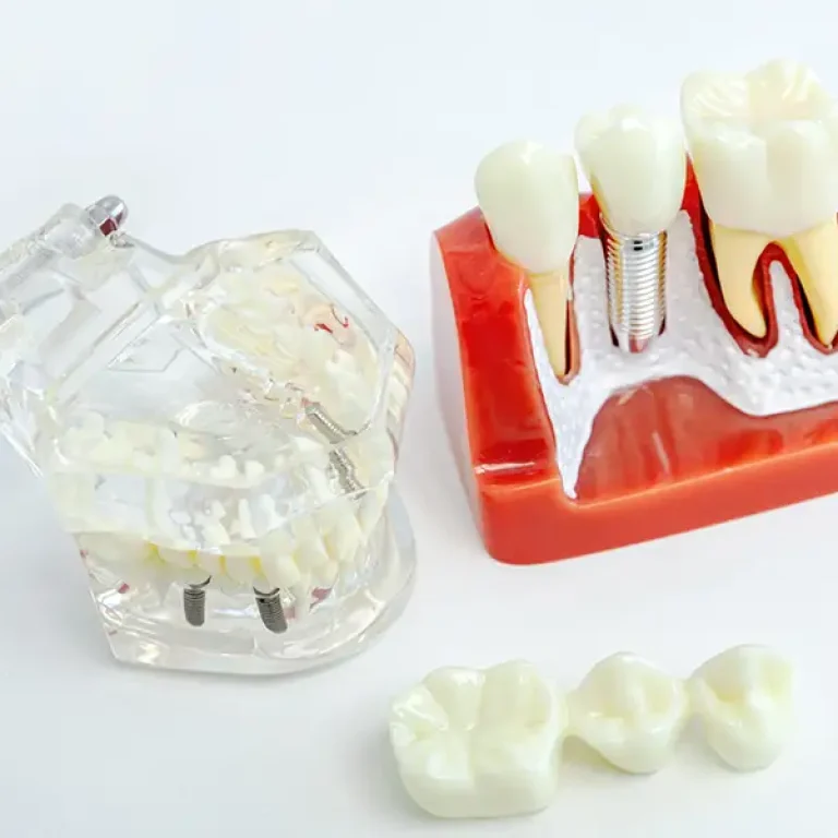 Dental Bridges vs Implants