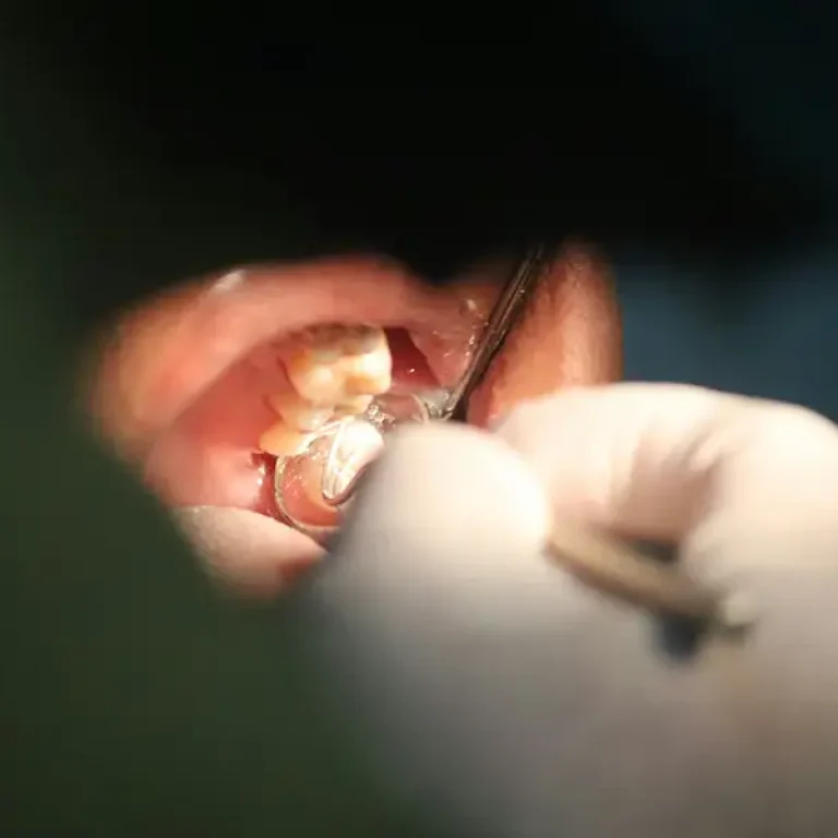 Wisdom teeth removal risks