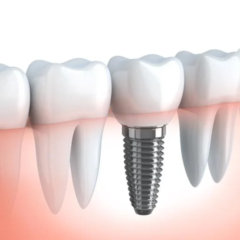 dental implants