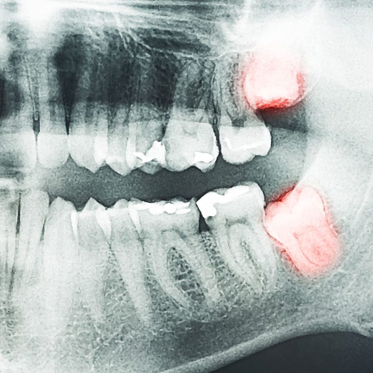 Wisdom Teeth Removal